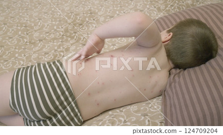 A child with a visible skin rash chickenpox is seen calmly resting on a bed, seeking comfort and care A child with a visible skin rash chickenpox is seen calmly resting on a bed, seeking comfort and care 124709204