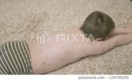 A child with a skin condition chickenpox lies on a bed, seeking comfort while monitored by parents 124709205