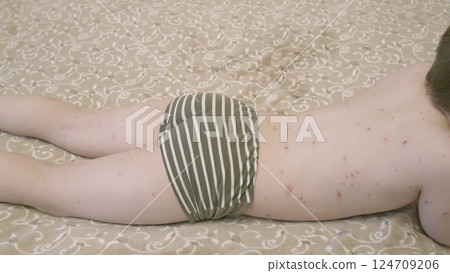 A child experiencing a skin rash chickenpox is resting comfortably on their bed to recover 124709206
