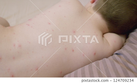 Child Experiencing Skin Irritation chickenpox on the Back Important Considerations for Parents Child Experiencing Skin Irritation chickenpox on the Back Important Considerations for Parents 124709234