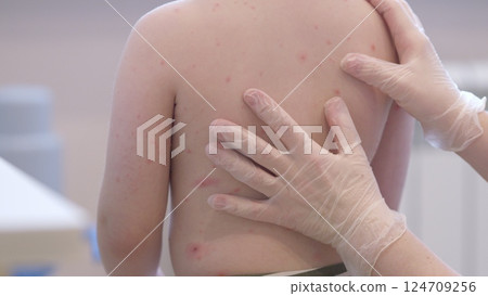 A child with a skin condition chickenpox is found enjoying themselves in a casual and playful environment 124709256
