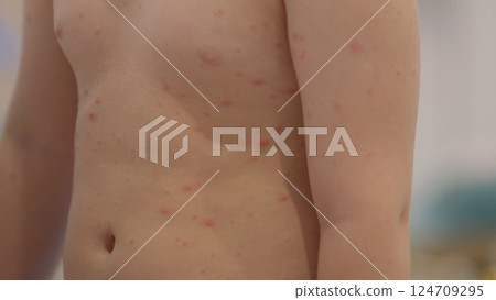 Chickenpox. A child experiencing skin irritation or a rash may require careful observation and treatment Chickenpox. A child experiencing skin irritation or a rash may require careful observation and treatment 124709295