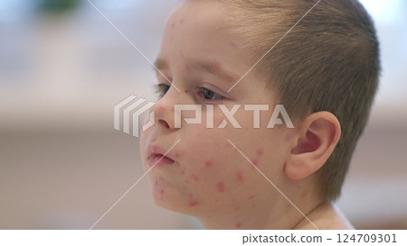 A closeup of a child with a distinct skin condition chickenpox, showcasing their unique beauty A closeup of a child with a distinct skin condition chickenpox, showcasing their unique beauty 124709301