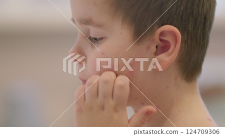 A young child suffering from a skin condition chickenpox, showcasing their unique journey and resilience 124709306