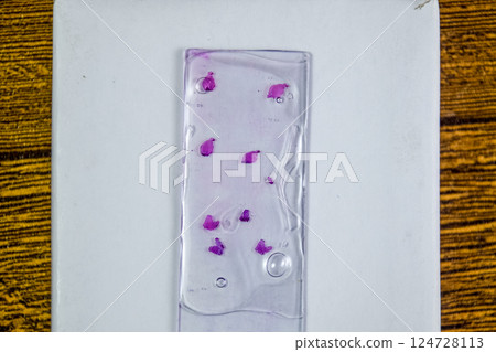 Slices of the tumor under glass. Histological examination of tumor cells for the presence of cancer 124728113