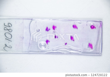 Slices of the tumor under glass. Histological examination of tumor cells for the presence of cancer 124728122