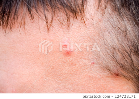 Pimples on the forehead of man. Acne on the forehead 124728171