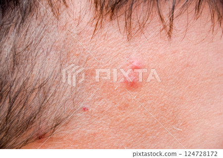 Pimples on the forehead of man. Acne on the forehead 124728172