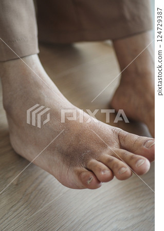 close up of women feet with swelling  124729387