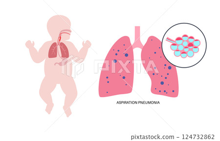 Aspiration pneumonia poster 124732862