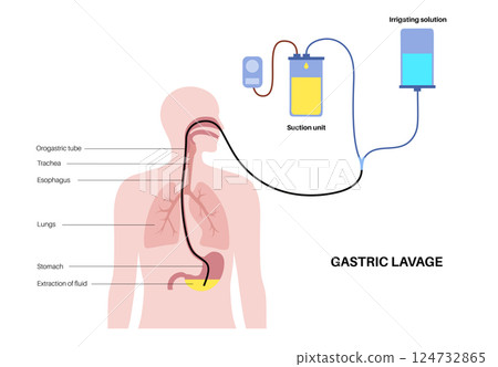 Stomach wash gastric lavage Stomach wash gastric lavage 124732865