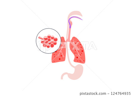 Aspiration pneumonia poster 124764935