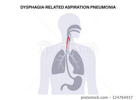 Aspiration pneumonia poster 124764937