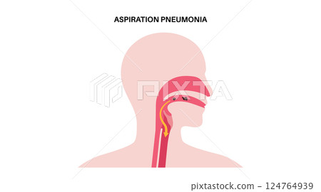 Aspiration pneumonia poster 124764939