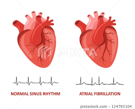 Heart diseases. Normal sinus rhythm and Atrial fibrillation. Medical check up. Vector illustration in flat cartoon style 124765104