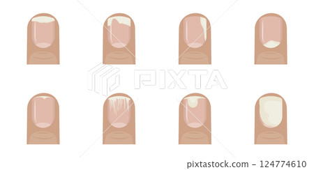 Types of onychosis affecting fingernails. 124774610