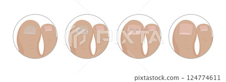 Podiatrist applying toenail correction staples step by step 124774611