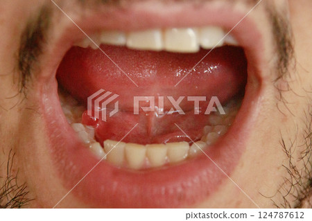 A close-up image of an open mouth showing an oral mucocoele or mucous cyst of the submandibular gland that look like translucent fluid-filled sac 124787612
