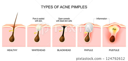 Types of acne pimples. Cross section of skin and hair follicle Types of acne pimples. Cross section of skin and hair follicle 124792612