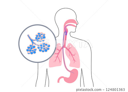 Aspiration pneumonia poster Aspiration pneumonia poster 124801363