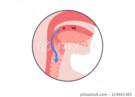 Aspiration pneumonia poster 124801365