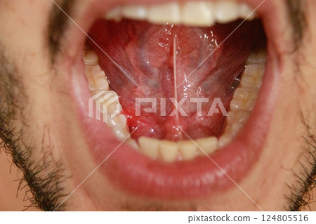 Close-up view of an open human mouth with the tongue lifted showing multiple oral mucocoele also known as a mucous cyst that appear as fluid-filled sacs that are translucent Close-up view of an open human mouth with the tongue lifted showing multiple oral mucocoele also known as a mucous cyst that appear as fluid-filled sacs that are translucent 124805516