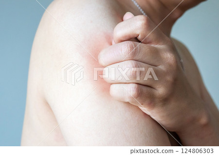 Young asian man itching and scratching on arm from allergic itchy dry skin eczema dermatitis insect bites Young asian man itching and scratching on arm from allergic itchy dry skin eczema dermatitis insect bites 124806303