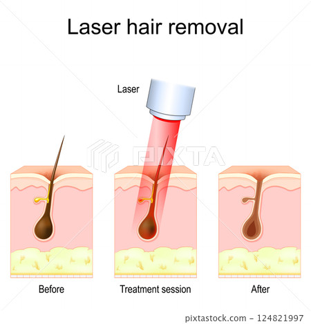 Laser hair removal Laser hair removal 124821997