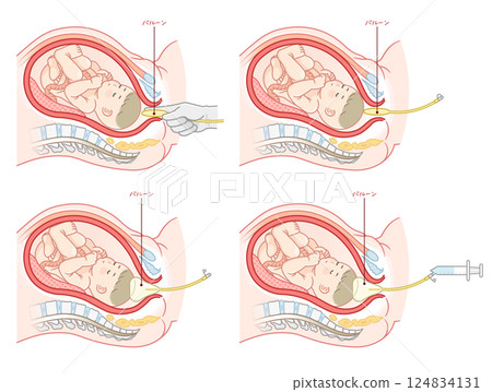 無痛分娩氣球圖 無痛分娩圖 124834131