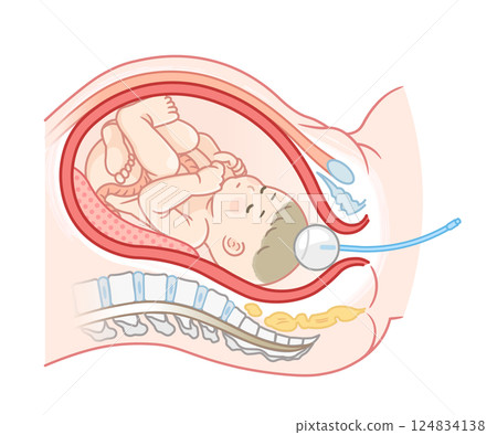 Painless childbirth balloon illustration Painless childbirth illustration 124834138