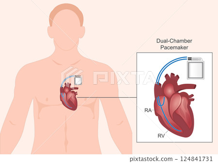 Dual chamber pacemaker.Type of pacemaker. 124841731