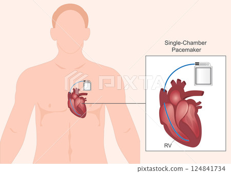 Single chamber pacemaker.Type of pacemaker. Single chamber pacemaker.Type of pacemaker. 124841734