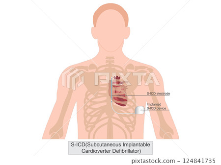 Subcutaneous implantable cardioverter... - Stock Illustration ...
