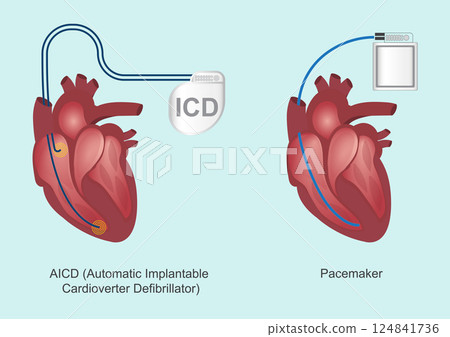 The difference between ICDs and pacemakers. The difference between ICDs and pacemakers. 124841736