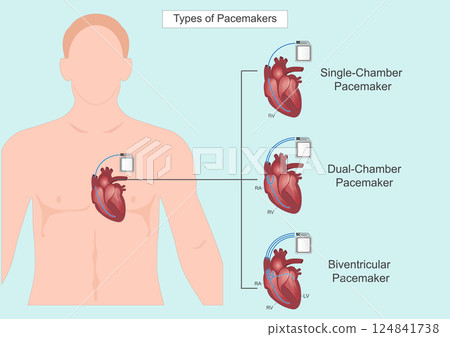 The different types of pacemakers. 124841738
