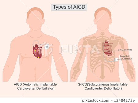 Type of AICD. 124841739