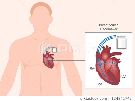 Biventricular pacemakers.Type of pacemaker. Biventricular pacemakers.Type of pacemaker. 124841742