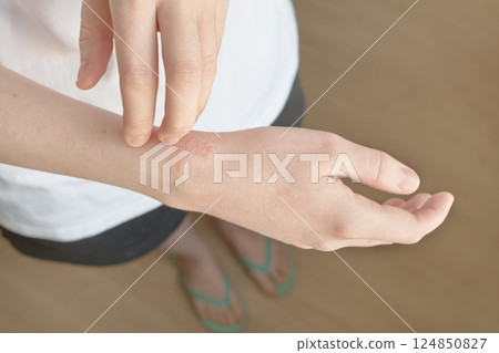 Managing eczema: close-up of skin condition and treatment concepts 124850827