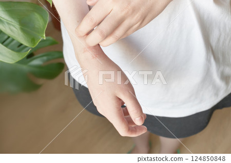 Young woman scratching eczema on her wrist close-up 124850848