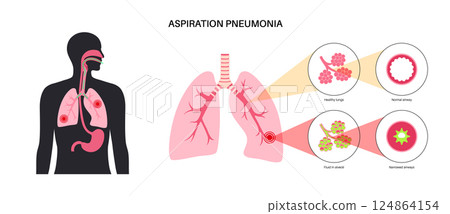 Aspiration pneumonia poster 124864154
