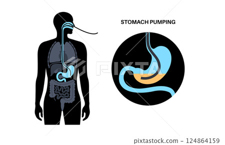 Stomach wash gastric lavage Stomach wash gastric lavage 124864159