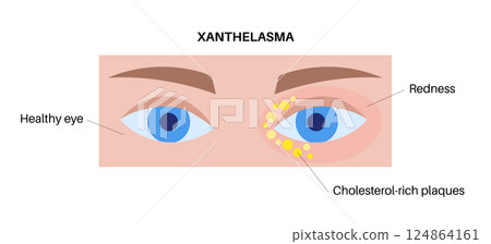 Xanthelasma skin disease 124864161