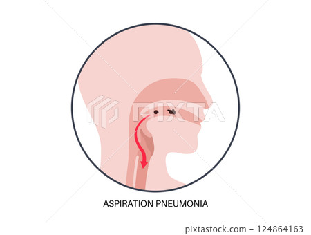 Aspiration pneumonia poster 124864163