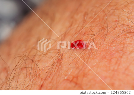 Leg injury in a girl. A severe injury while running in the mountains. 124865862