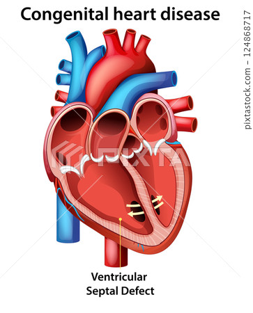 Ventricular Septal Defect in Congenital Heart Disease 124868717