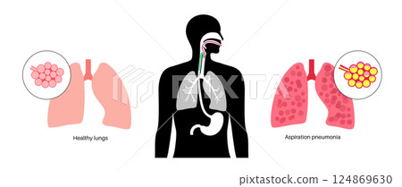 Aspiration pneumonia poster 124869630