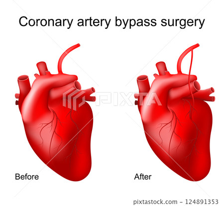 Coronary artery bypass. Bypass grafting. Heart surgery. 124891353