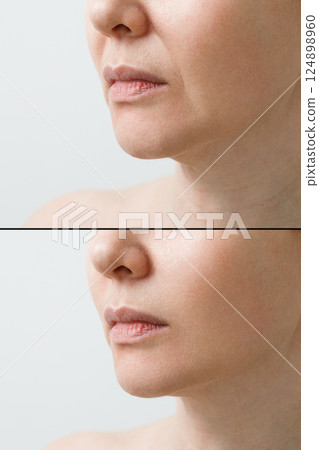 Female nasolabial fold before and after wrinkle smoothing procedures. Correction of the chin and neck shape. 124898960