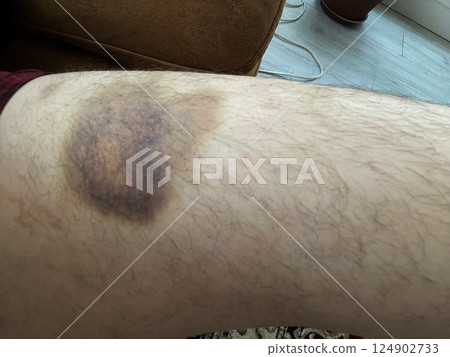 bruise on the leg. hematoma. purple bruise bruise on the leg. hematoma. purple bruise 124902733