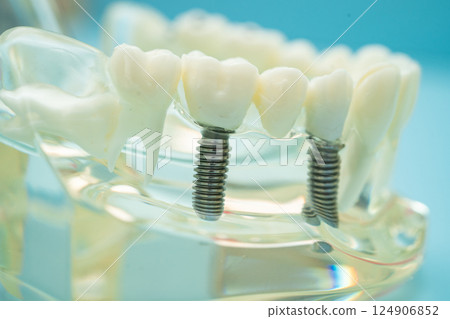 Dental implant, artificial tooth roots into jaw, root canal of dental treatment, gum disease, teeth model for dentist studying about dentistry. 124906852
